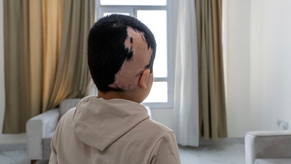 Au moins 21 000 enfants palestiniens sont handicapés depuis le début de la guerre à Gaza