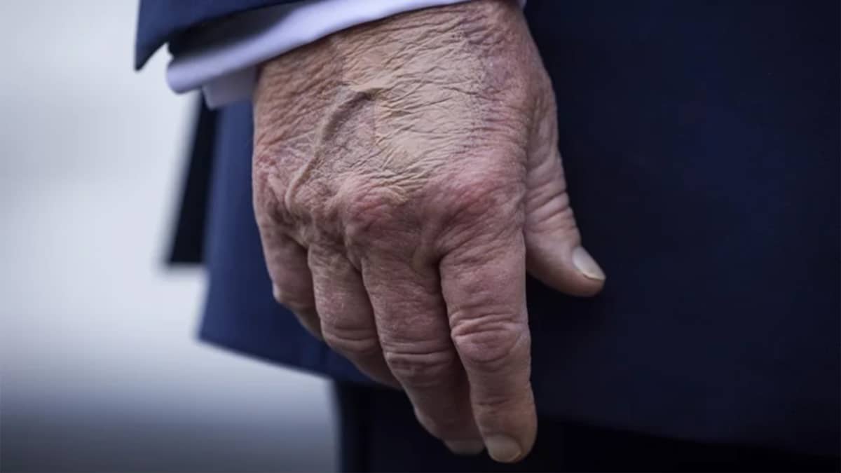 La mauvaise santé de Trump, un secret de polichinelle